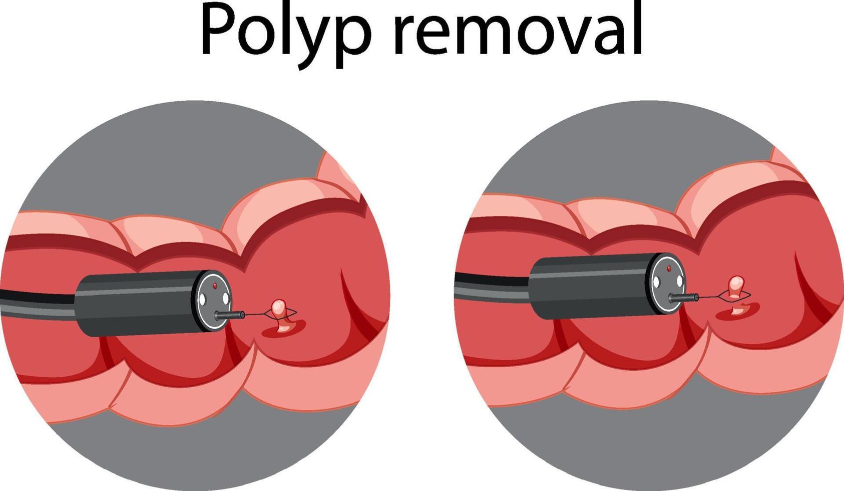 diagrama que muestra la extirpación de pólipos vector