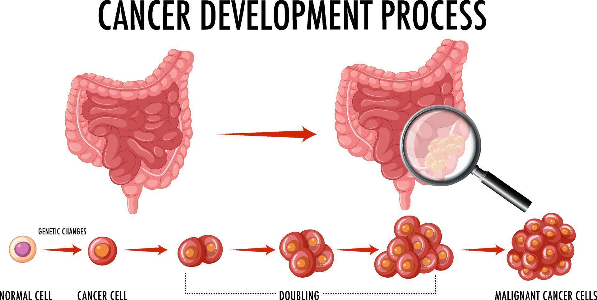 diagrama que muestra el proceso de desarrollo del cáncer vector