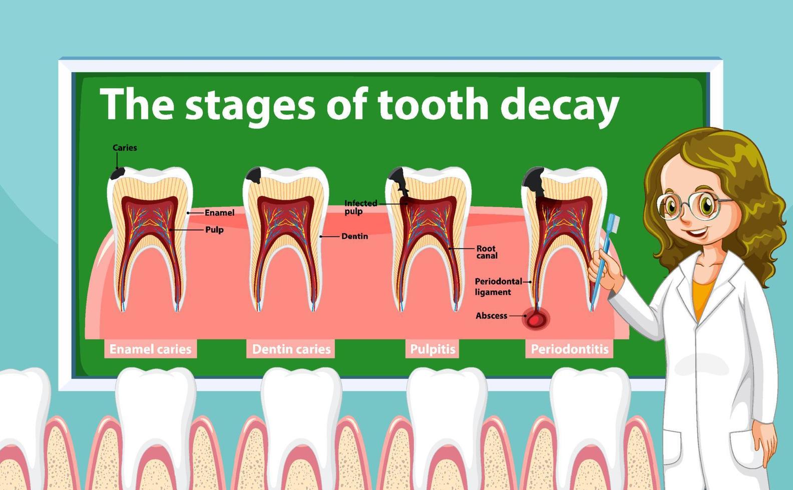 infografía de humanos en las etapas de la caries dental vector