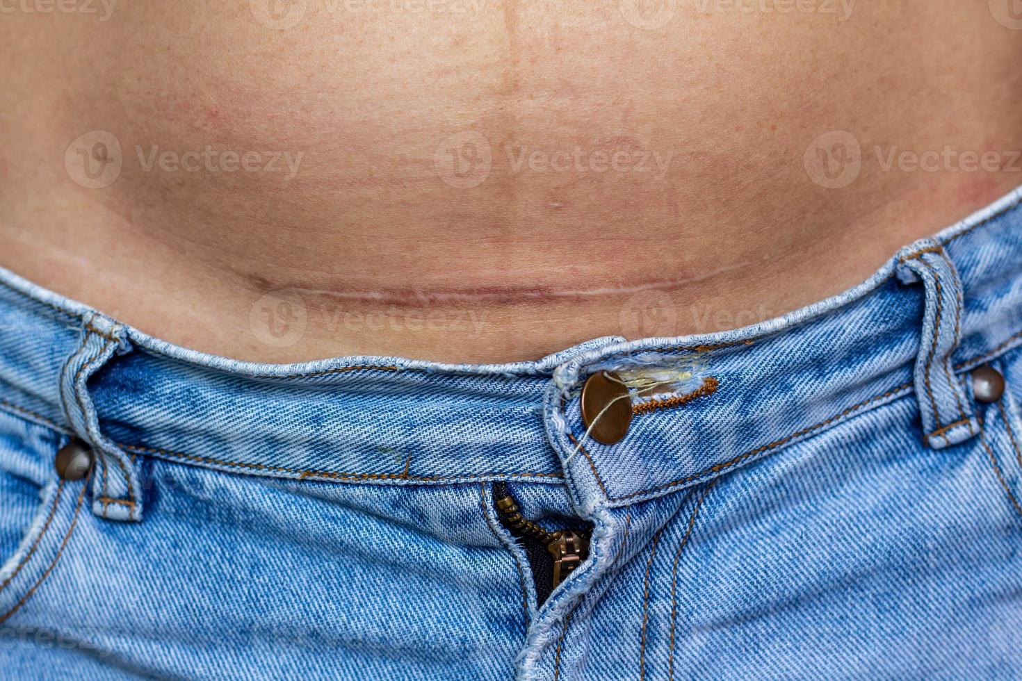 Scar on the abdomen of a woman who had a caesarean section. photo