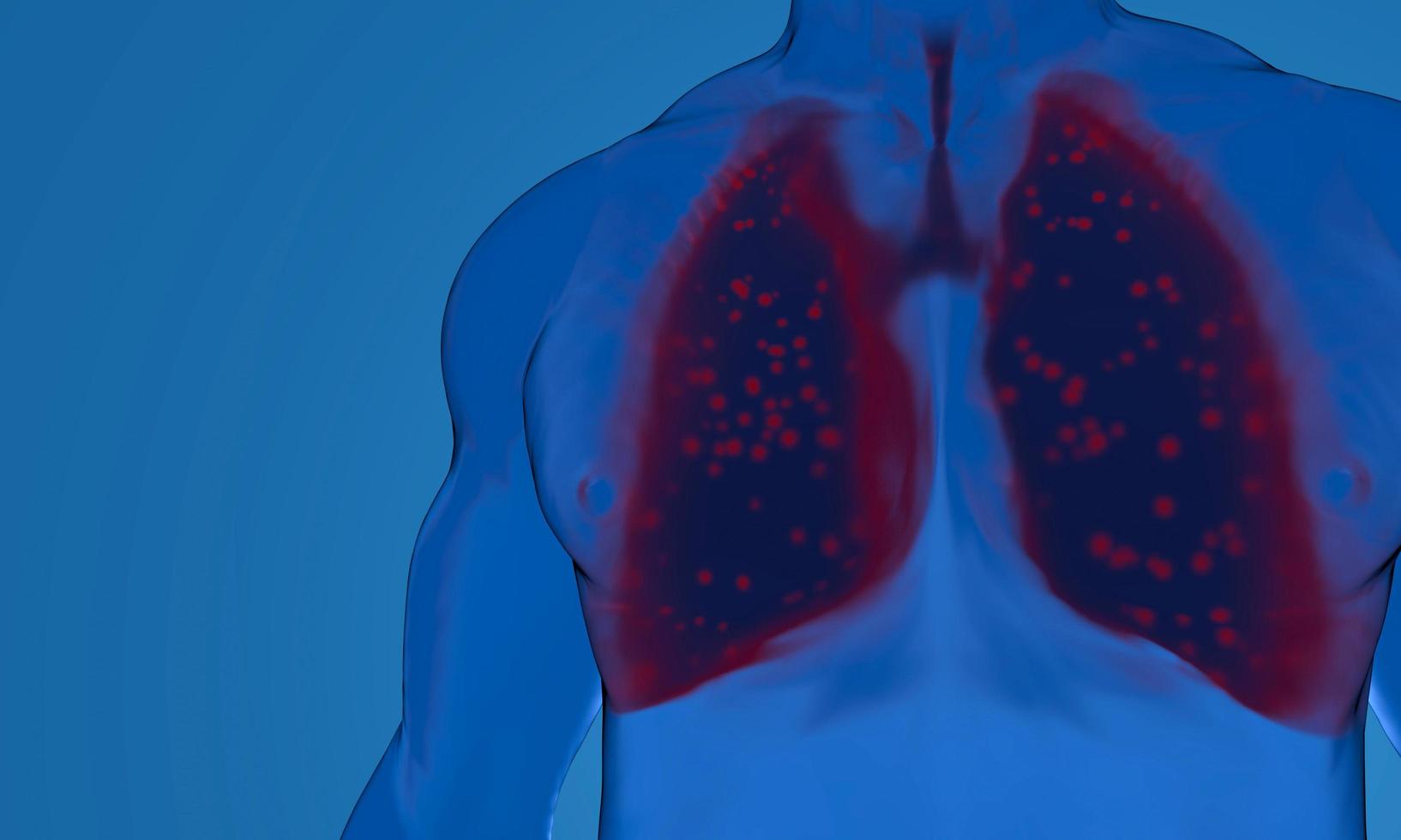 Pneumonia by Corona Virus  in the lung. coronavirus attacking lung with severe pneumonia disintegrating it, leading to death. 3D rendering. photo