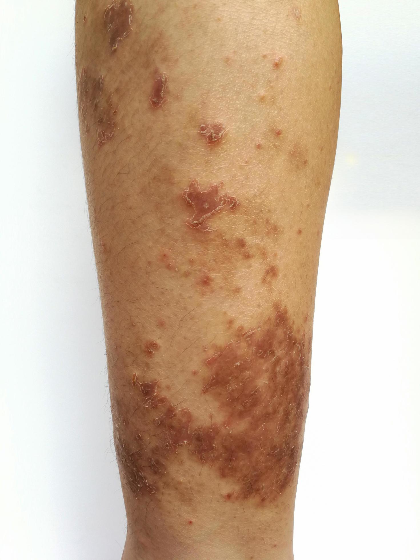 Young boy has Chronic rash on skin. Grass allergic skin disease. Atopic