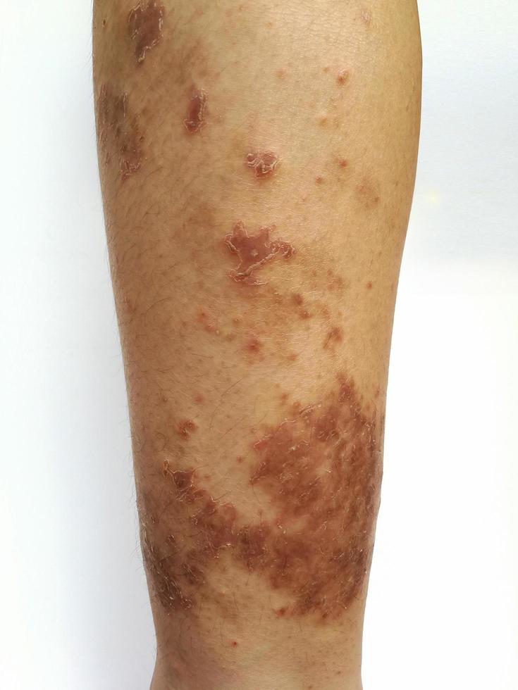 Young boy has Chronic rash on skin. Grass allergic skin disease. Atopic dermatitis. Age spot skin photo