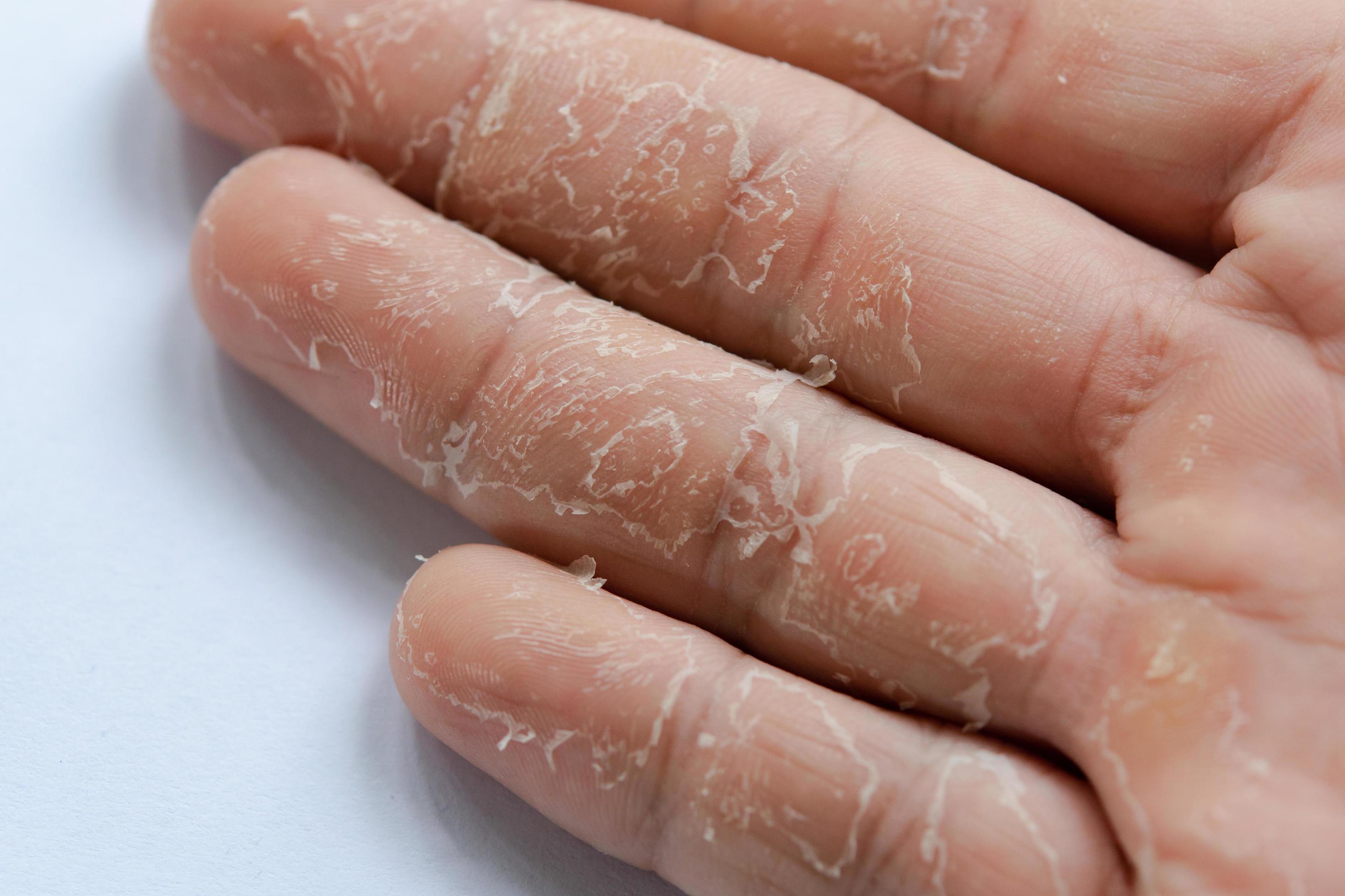 Skin peeling on sale on hands