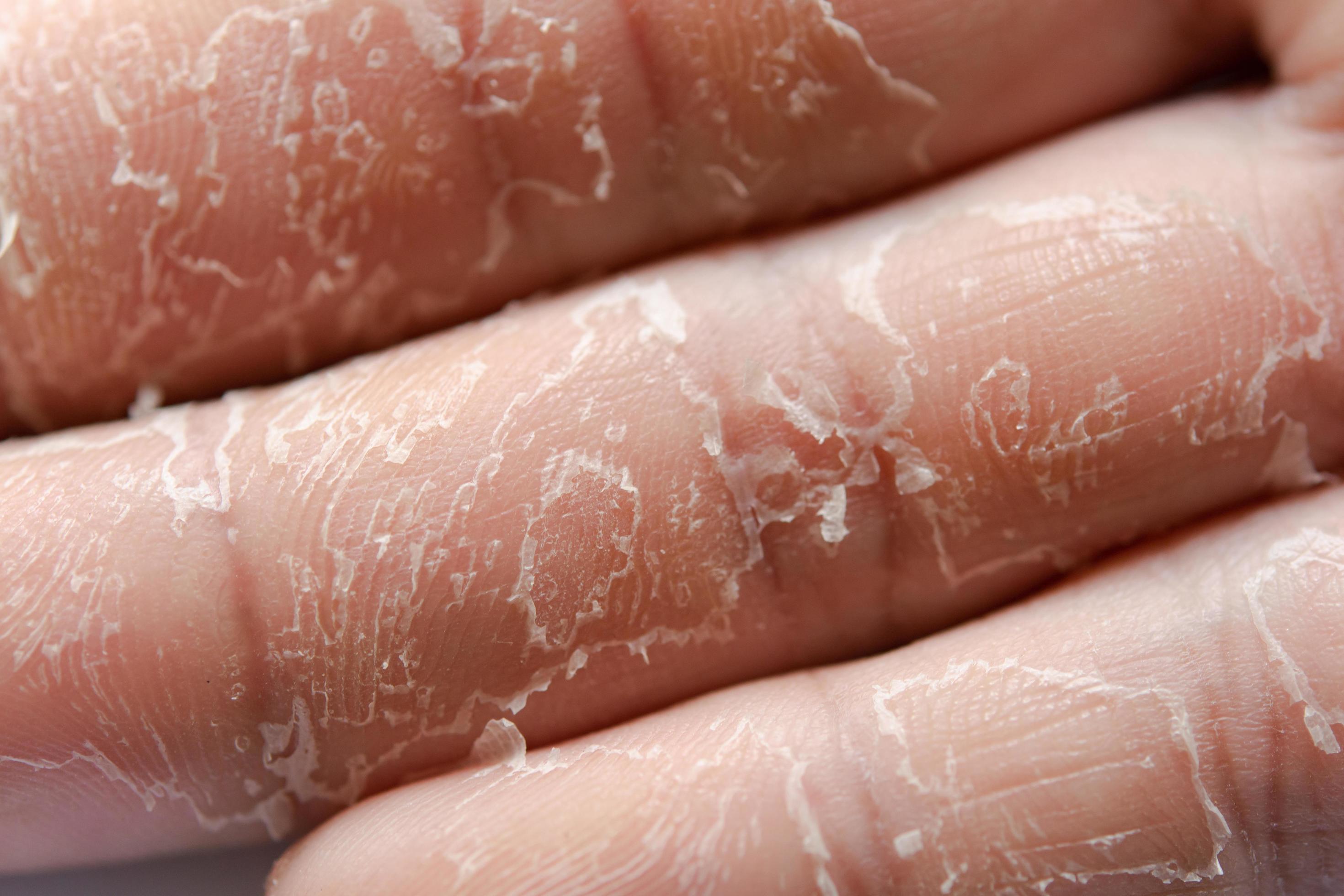 Peeling skin on hand and fingers. Desquamation 6663096 Stock Photo at