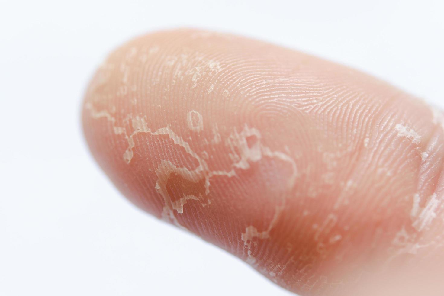 Peeling skin on hand and fingers. Desquamation photo