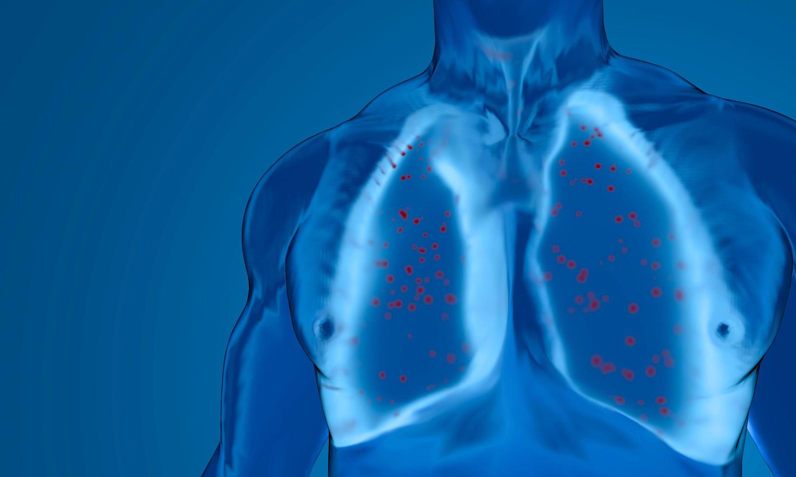 Pneumonia by Corona Virus  in the lung. coronavirus attacking lung with severe pneumonia disintegrating it, leading to death. 3D rendering. photo