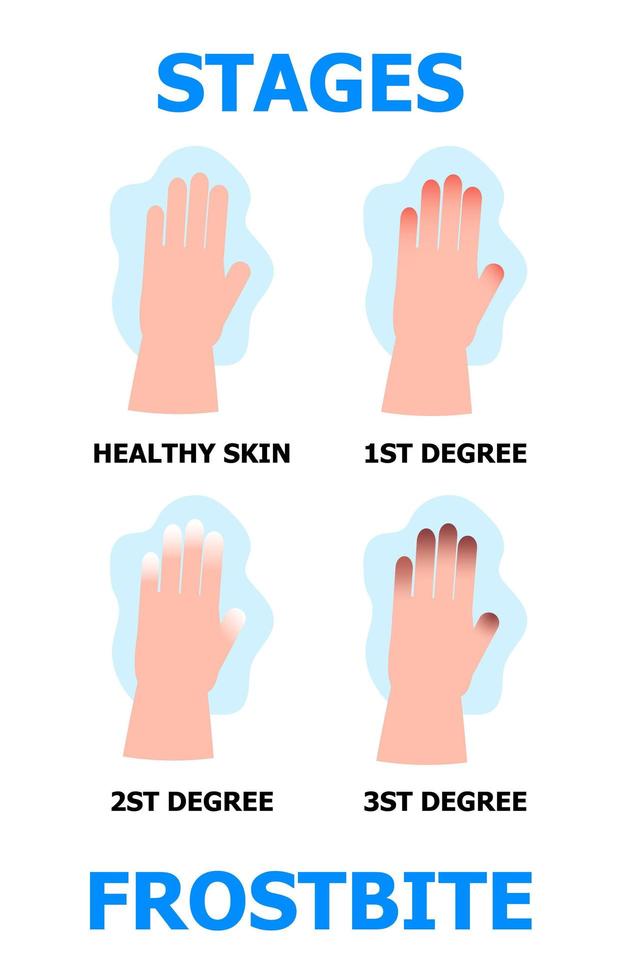 Frostbite stages info-graphic vector. Hypothermia in winter season. Problems with skin of frost fingers vector