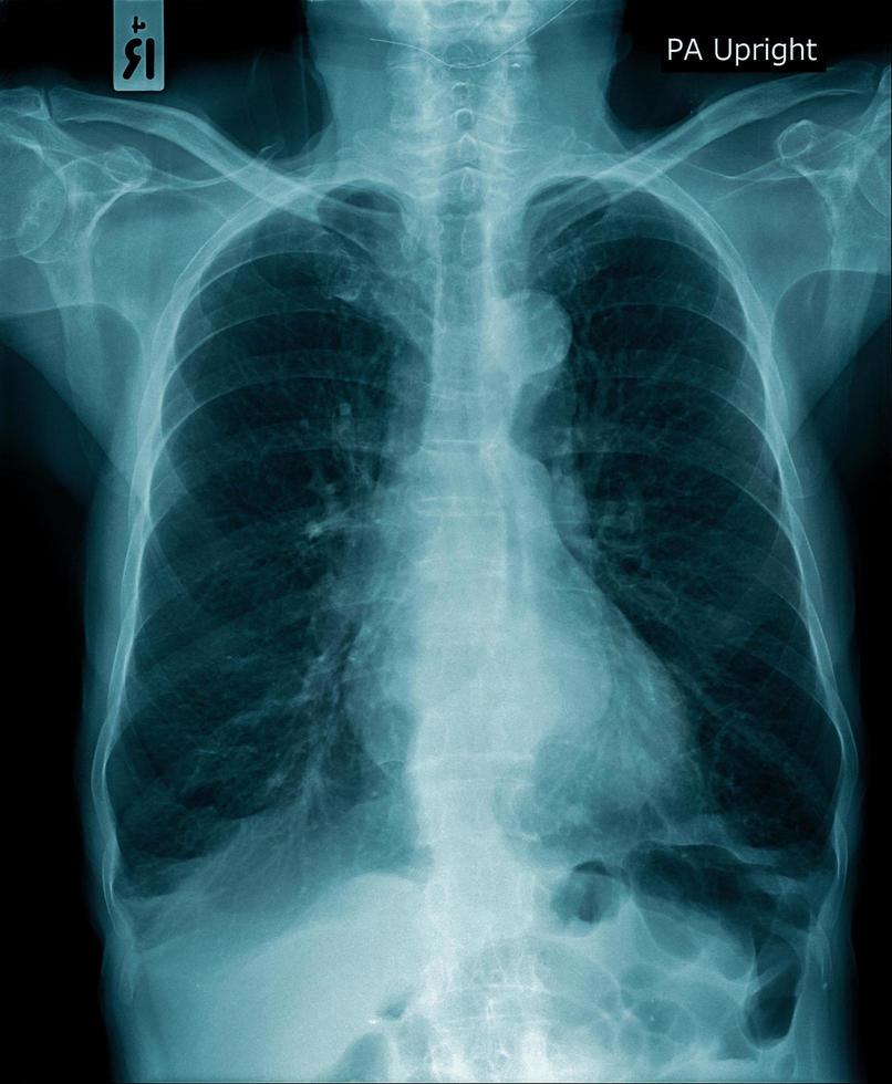 human x-ray image, chest x-ray photo