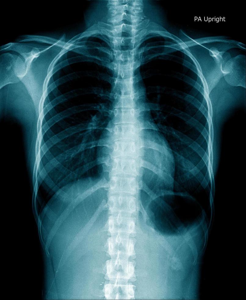 chest x-ray show inside of lung photo