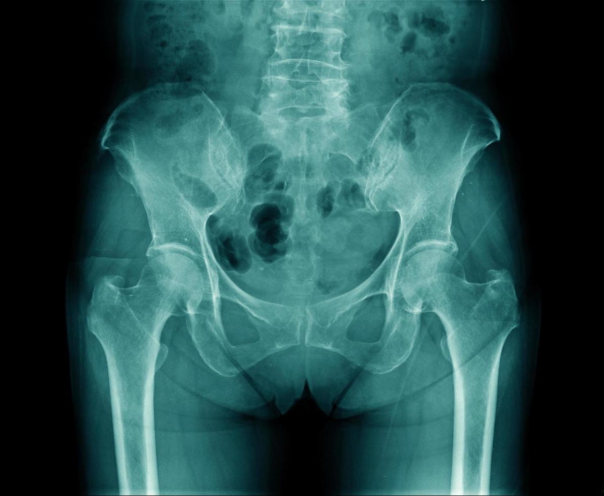 radiografía del hueso pélvico y parte del hueso lumbar con articulación de la cadera en tono azul foto
