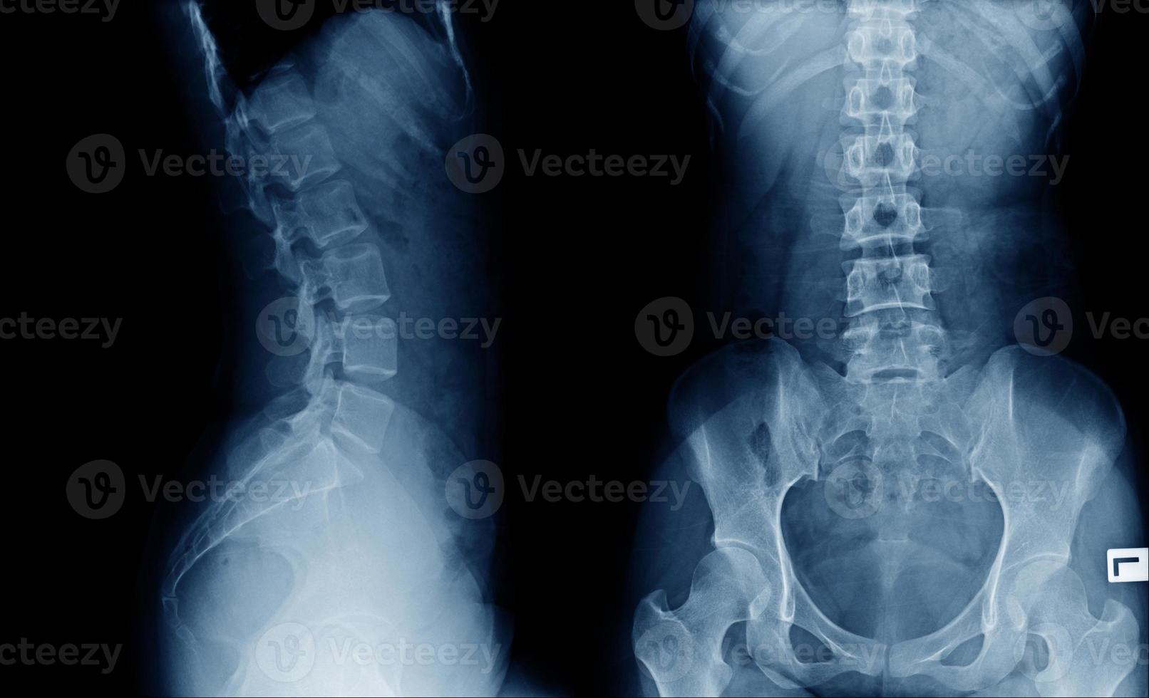back x-ray image AP and lateral view in blue tone photo