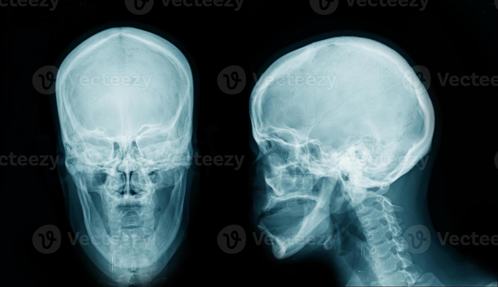 x-ray skull AP and lateral view photo