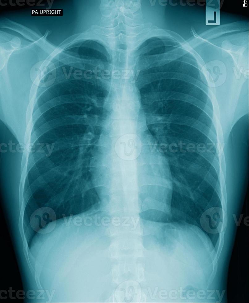 imagen de rayos X de tórax con fondo negro de tono azul, infección pulmonar con secreción foto