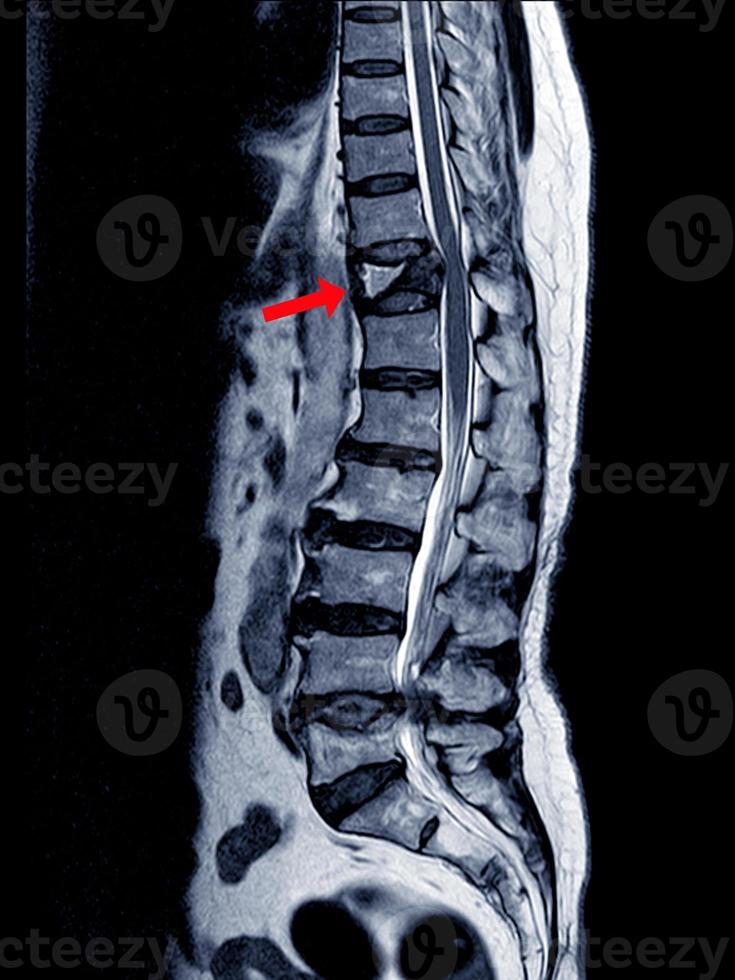 MRI Thoracic lumbar spine show moderate pathological compression fracture of T12 level. photo
