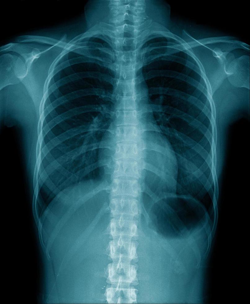 espectáculo de rayos x de tórax dentro del pulmón foto