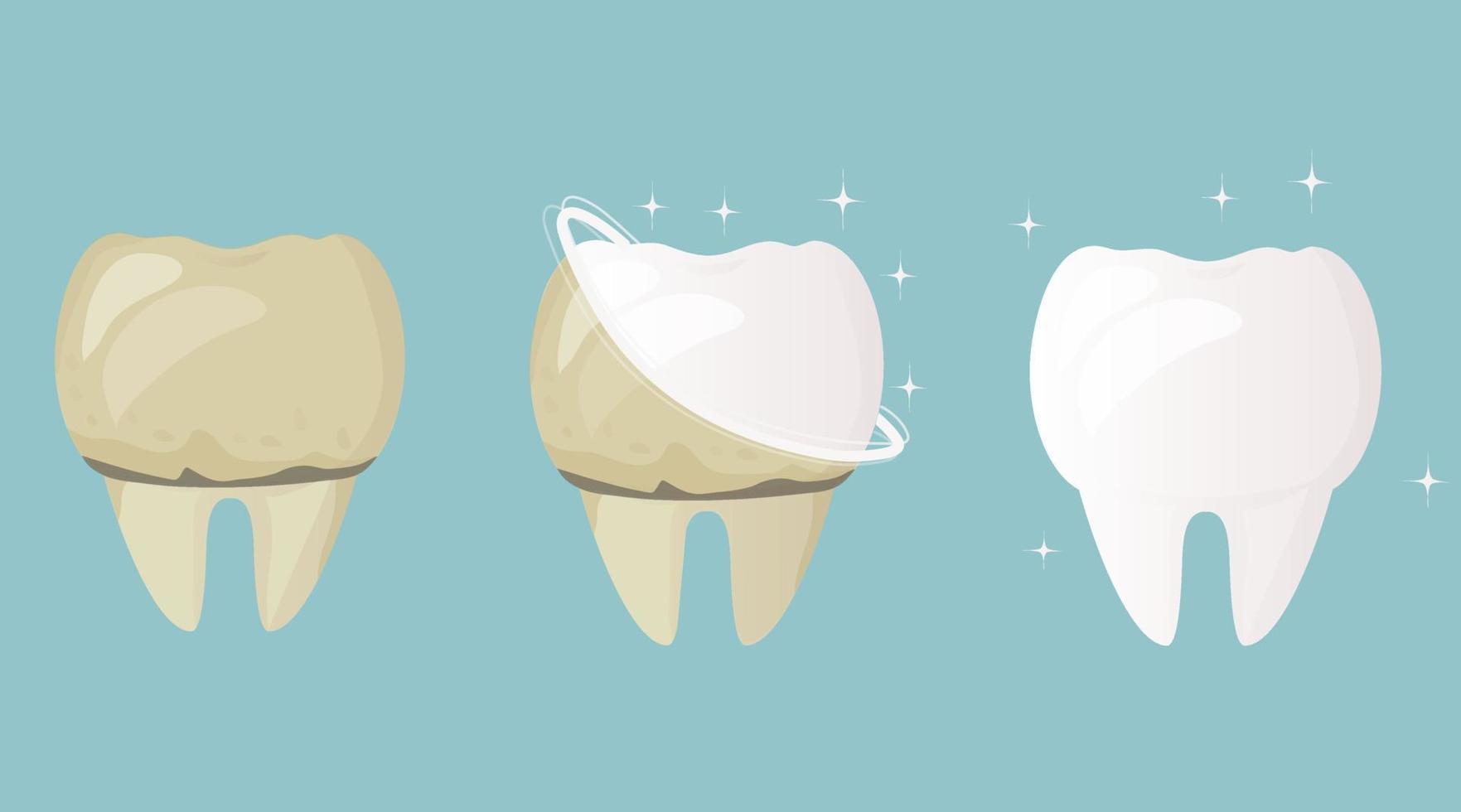 blanqueamiento y limpieza dental. diente antes del tratamiento y cepillado amarillo y enfermo, después blanco y sano. higiene bucal diaria. cartel de diseño dental vector