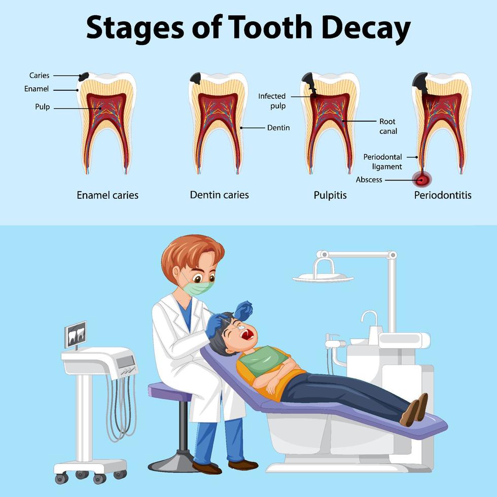 etapas del cartel de la caries dental con el hombre dentista examinando los dientes del paciente vector