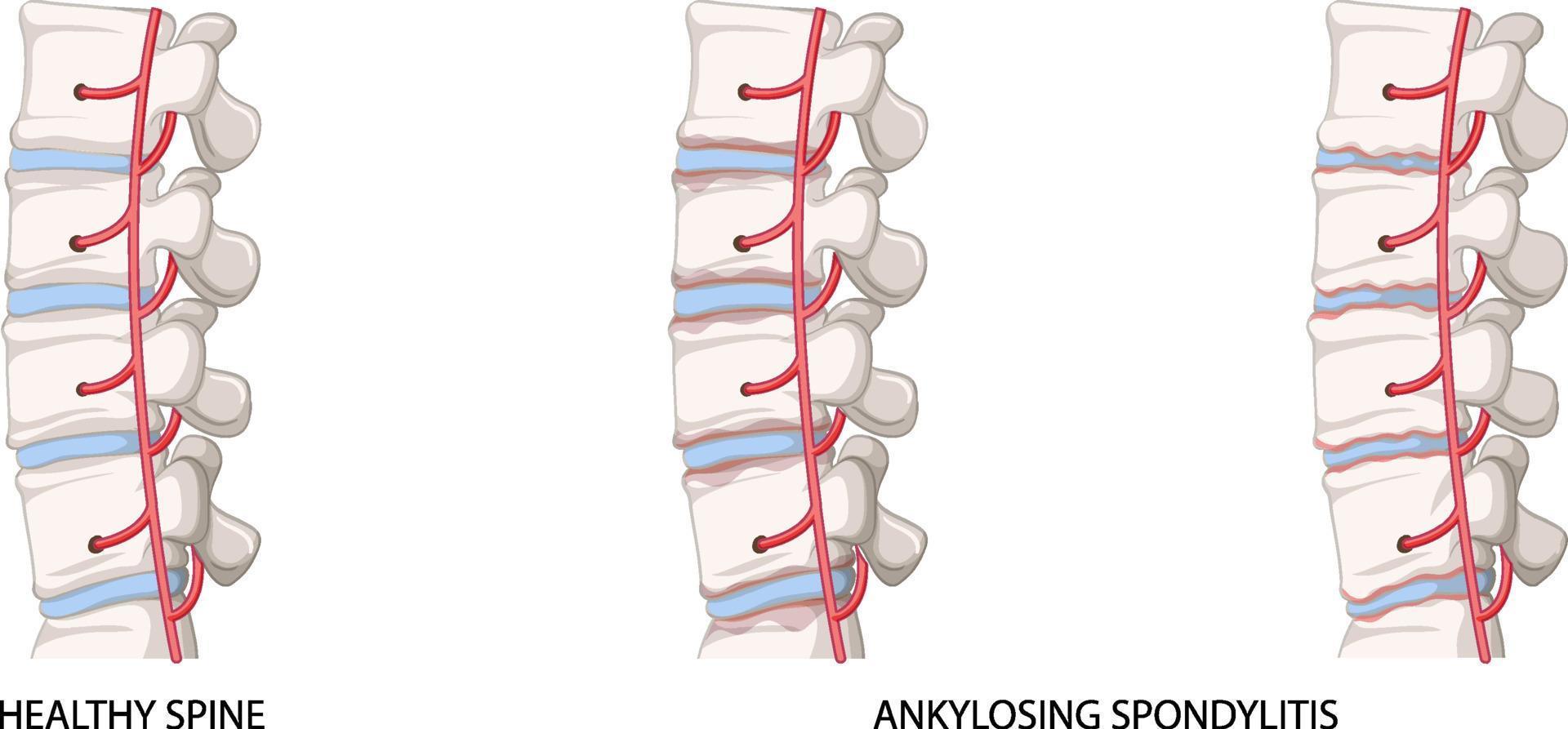 infografía de columna sana y espondilitis anquilosante vector