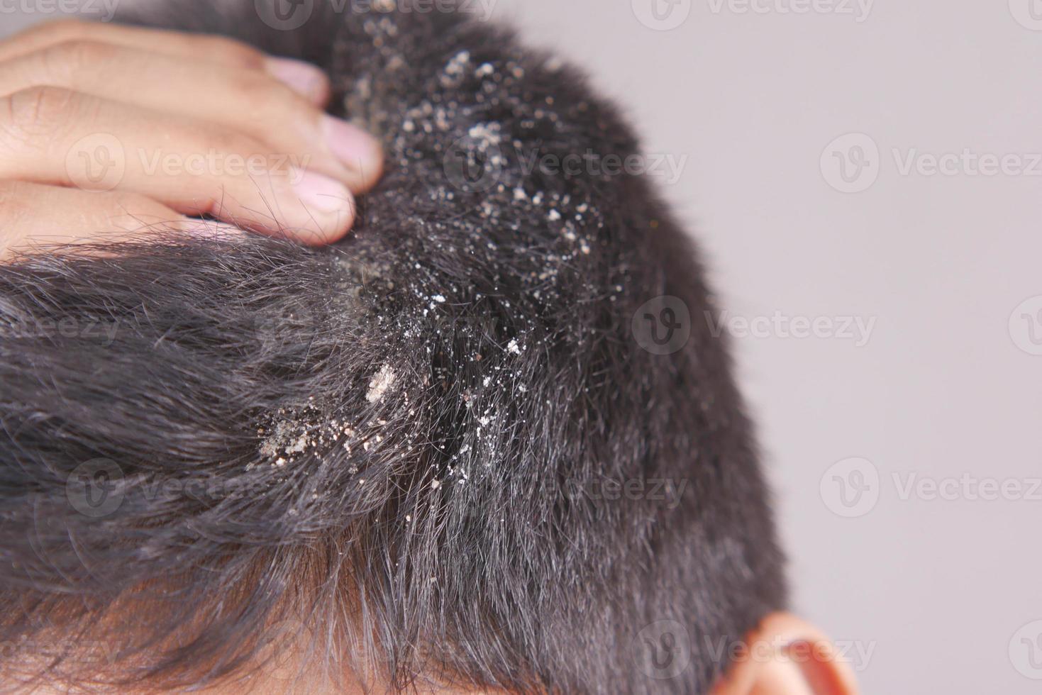 hombres con caspa en el cabello, primer plano foto