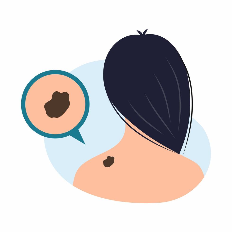 mujer joven con marca de nacimiento en el área del cuello. día mundial del melanoma. tumor canceroso. ilustración vectorial sobre el tema de la medicina y los problemas de salud. vector