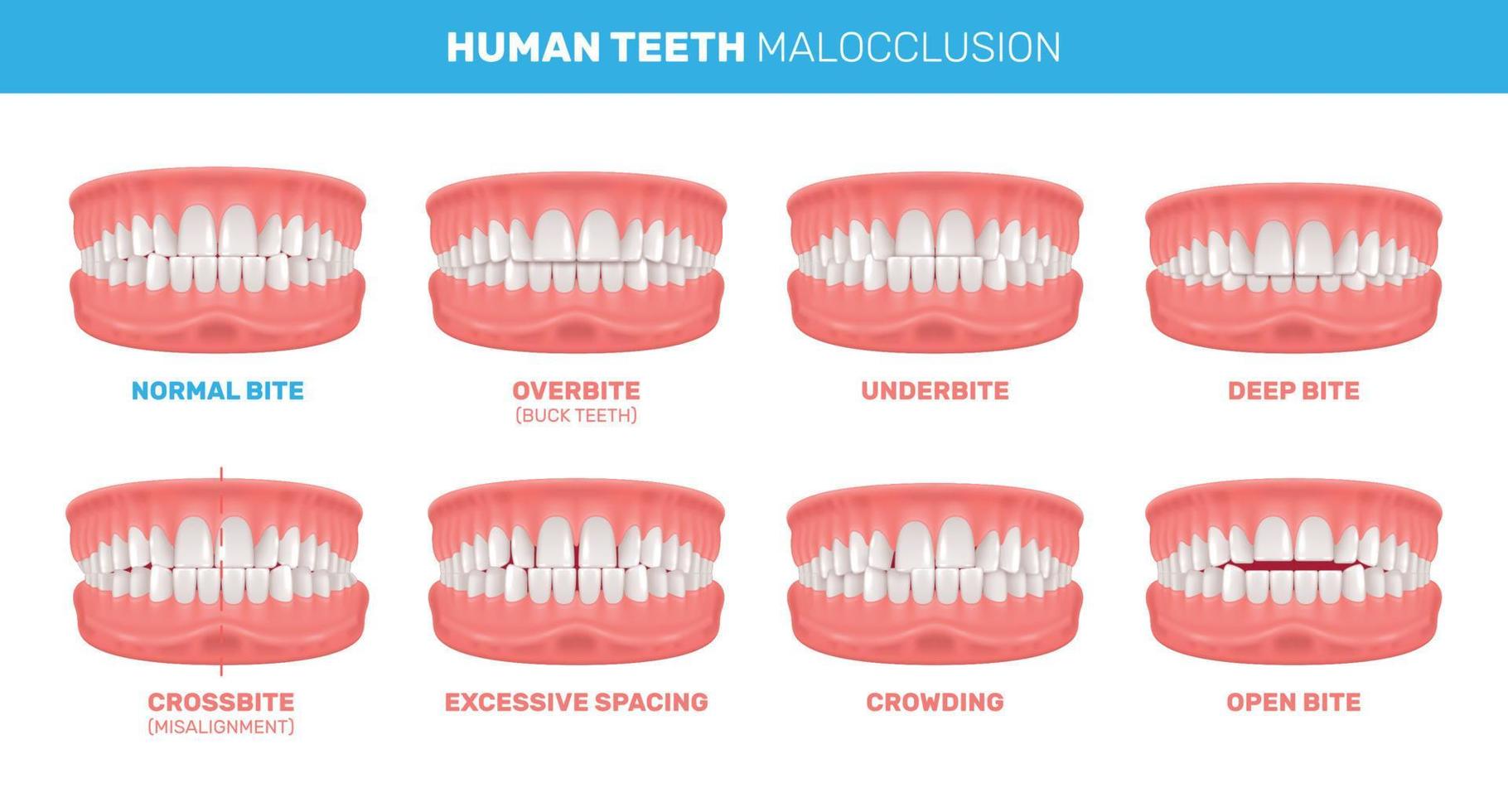 Maloclusión de las infografías de los dientes. vector