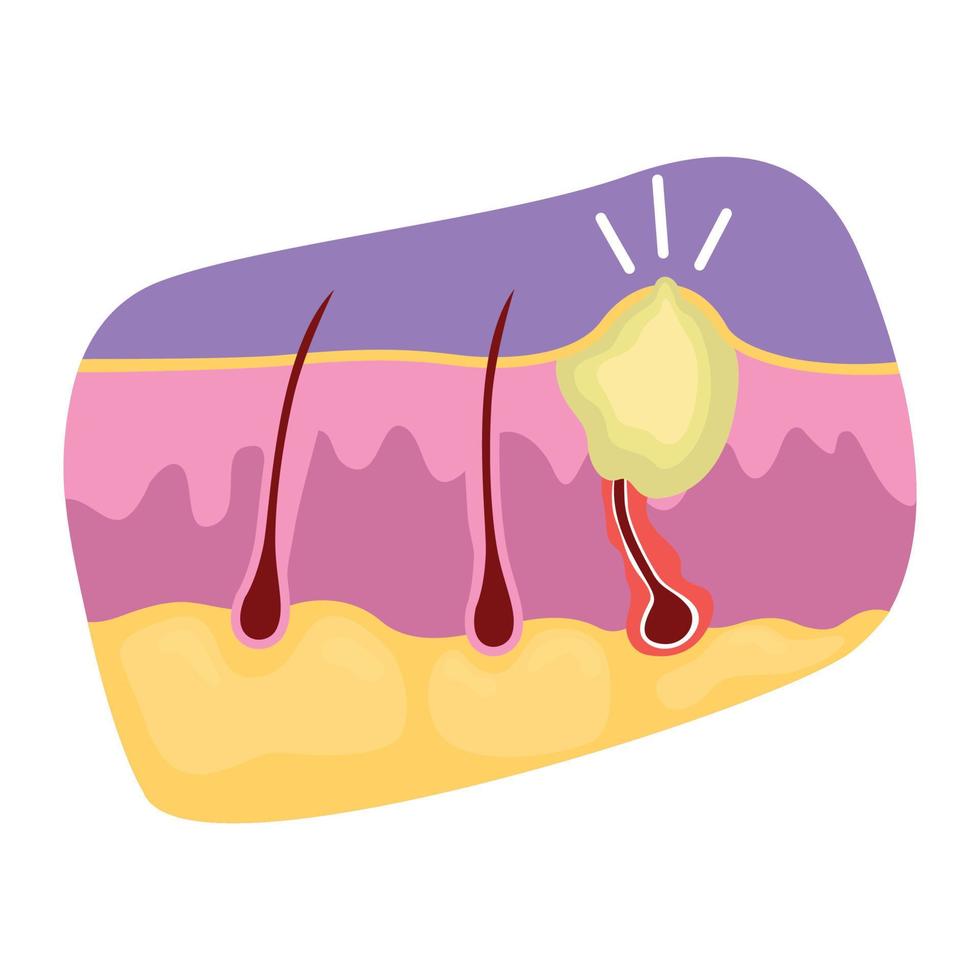 Pimple with ingrown hair 2D vector isolated illustration