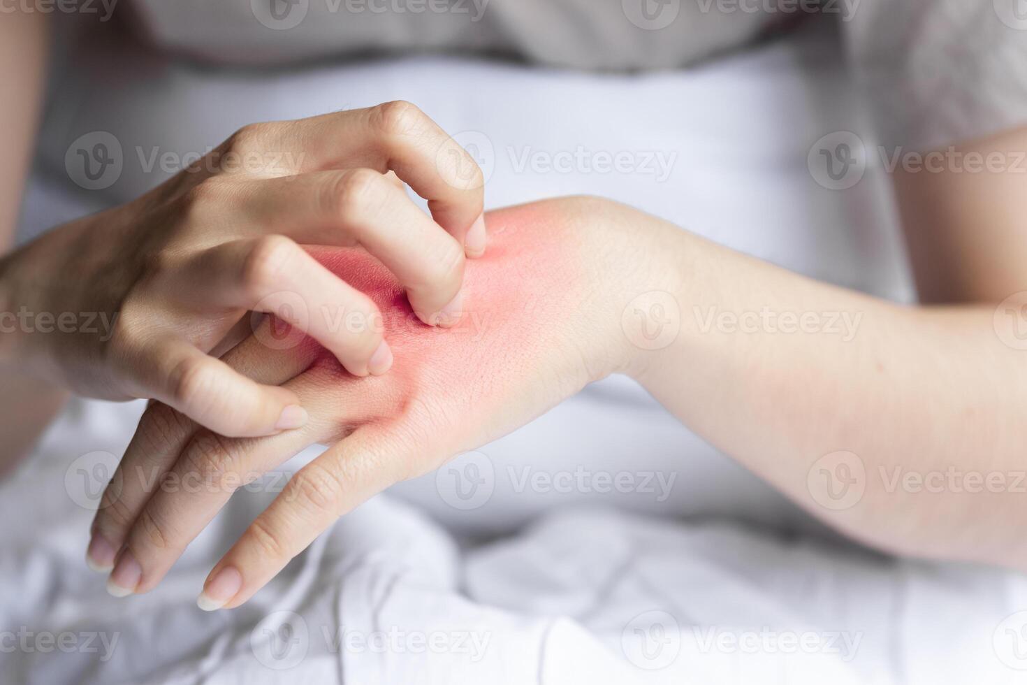 Closeup woman's hand scratching red rash on back of hand due to body allergy or insect bite