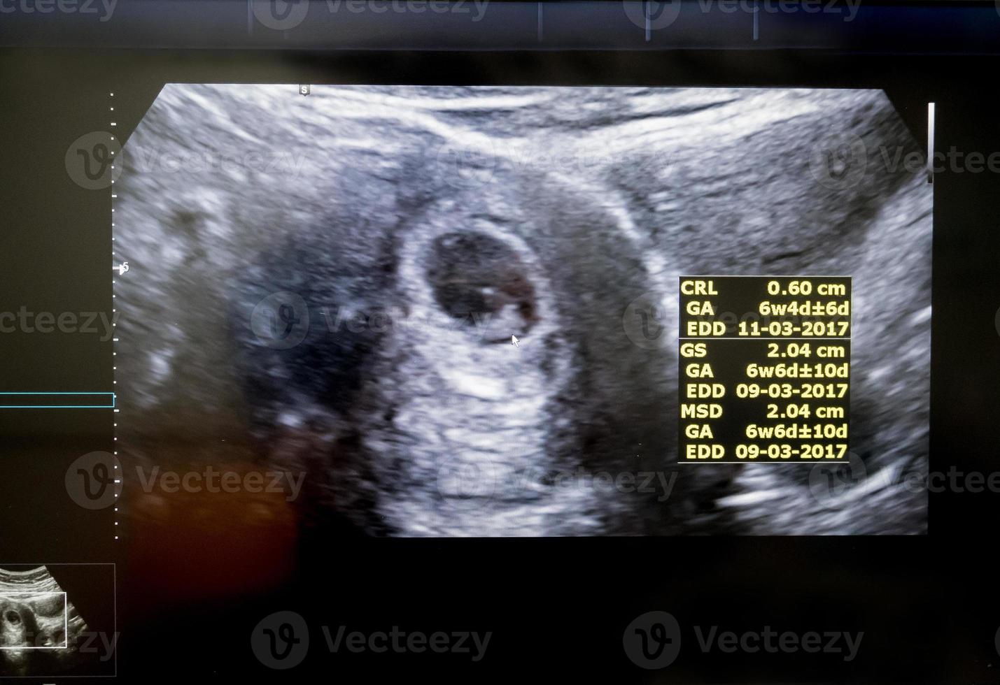 Obstetric Ultrasound of embryo at sixth week photo