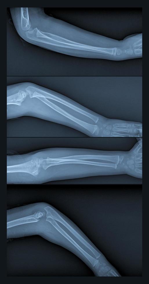 Broken arm xray photo