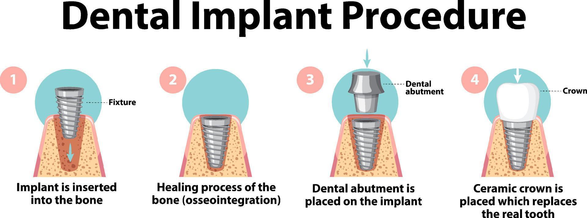 Infographic of human in dental implant procedure vector