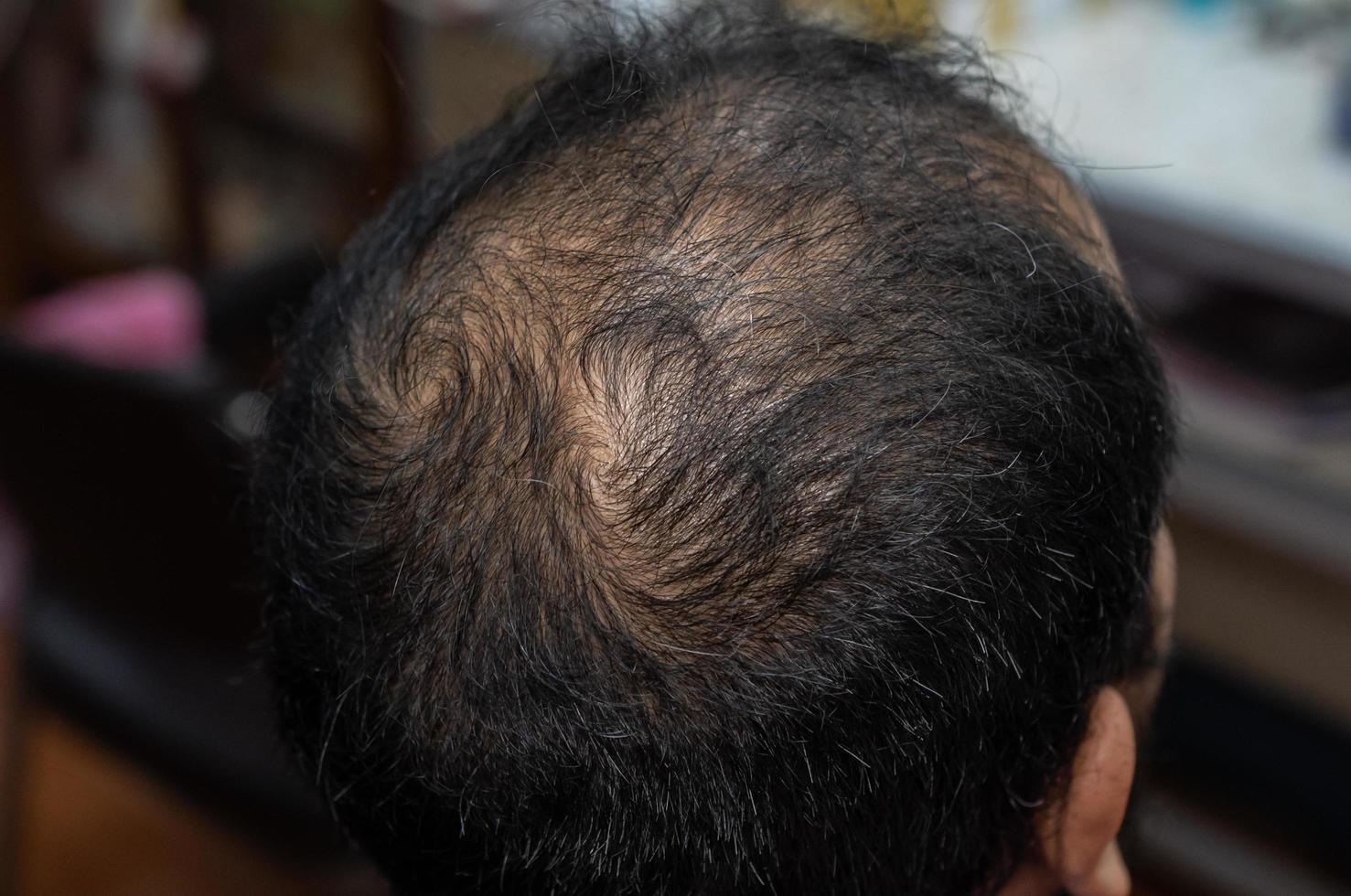 Top view of Asian male pattern baldness. Hair loss or alopecia can affect just your scalp or your entire body. It can be the result of heredity, hormonal changes or a normal part of aging. photo