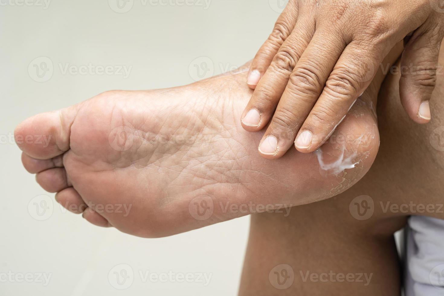 Woman care feet with cracked and dry heel skin cream at home. photo