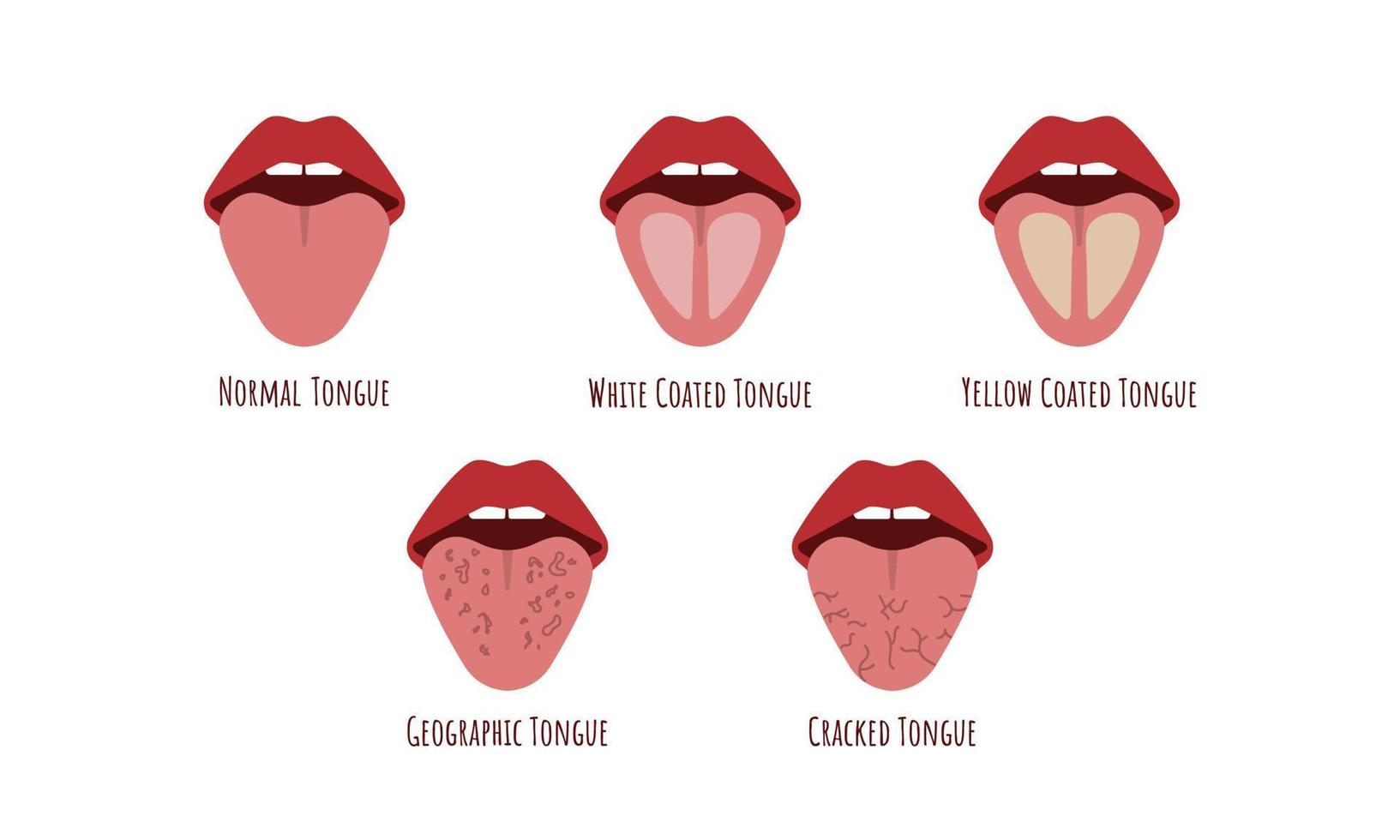 Tongue problems. White Yellow coated, Cranched, Geographic tongue. Oral thrush. Candidiasis on the tongue. Fungus in the mouth. Vector