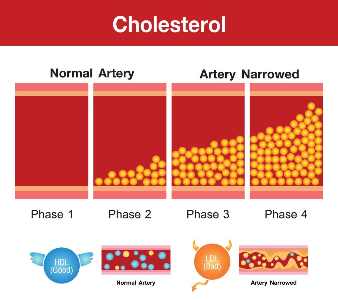 colesterol en la arteria, riesgo para la salud, diseño vectorial vector