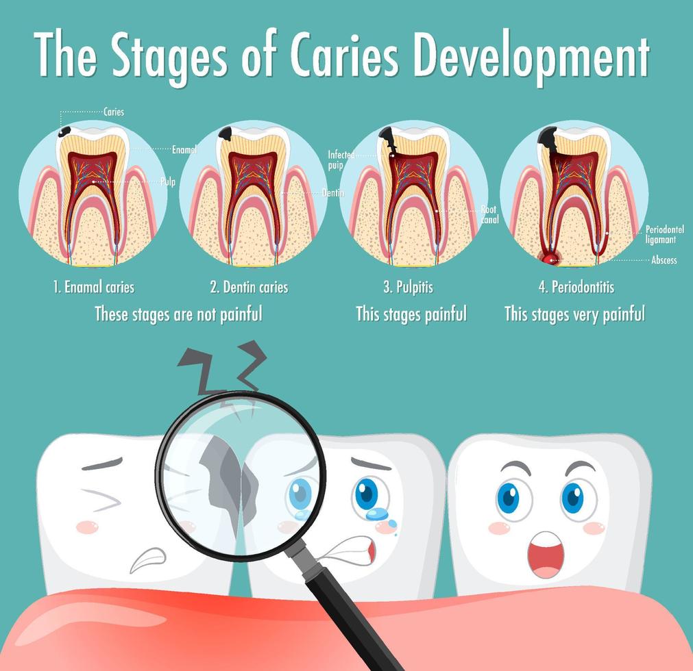 infografía de humanos en etapas de desarrollo de caries vector