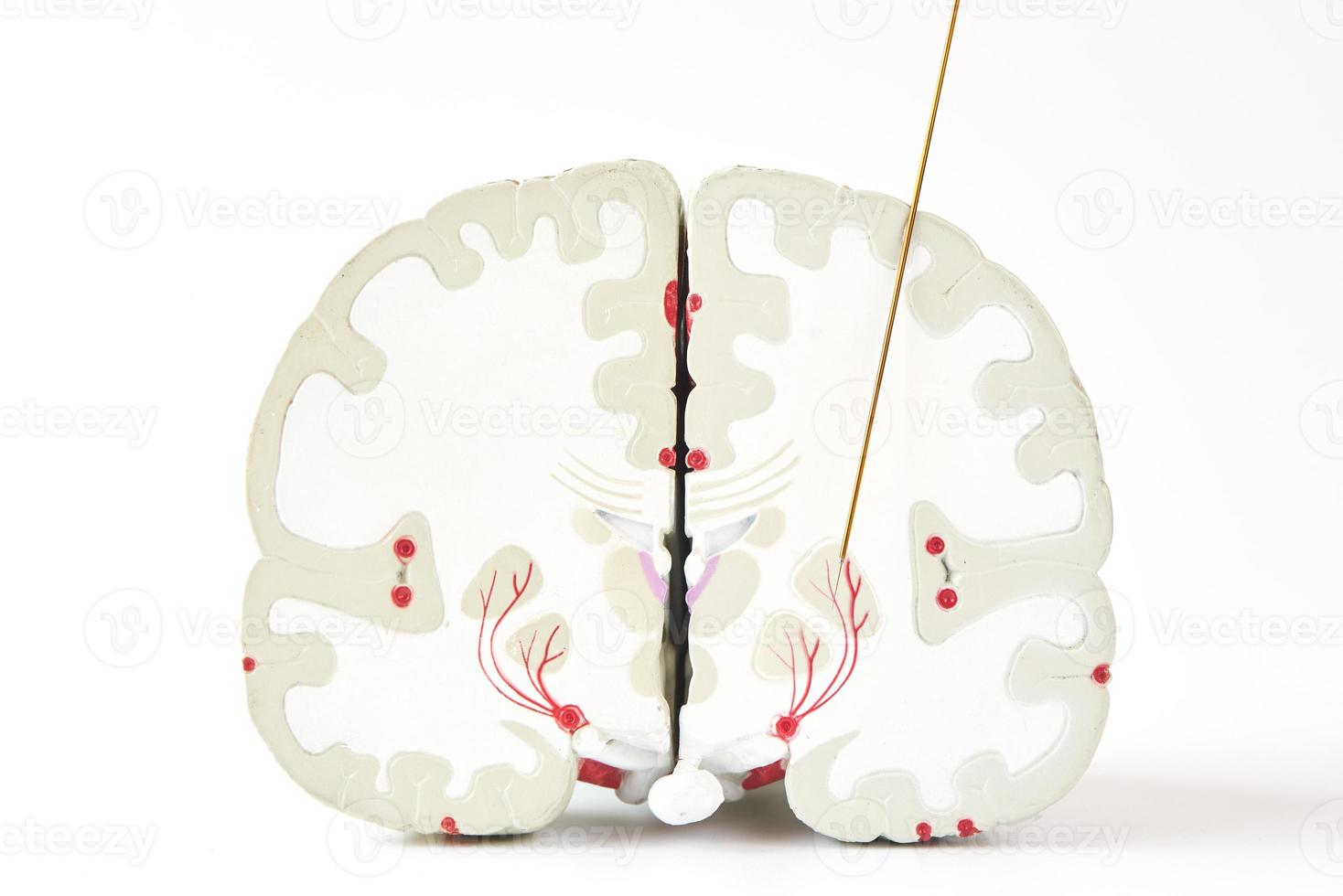 Microelectrode recording of globus pallidus in Parkinson's disease surgery photo