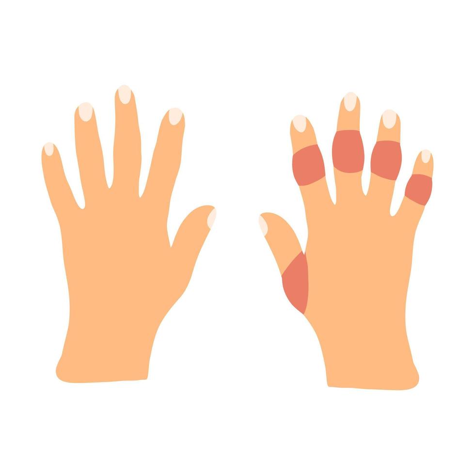 Hands with rheumatoid arthritis disease in cartoon flat style. Vector illustration of sick stiffness swollen joints. Human disorder.