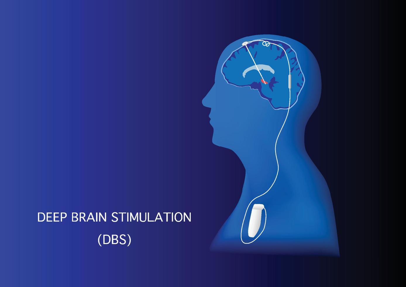 Deep brain stimulation for treatment of Parkinson disease vector