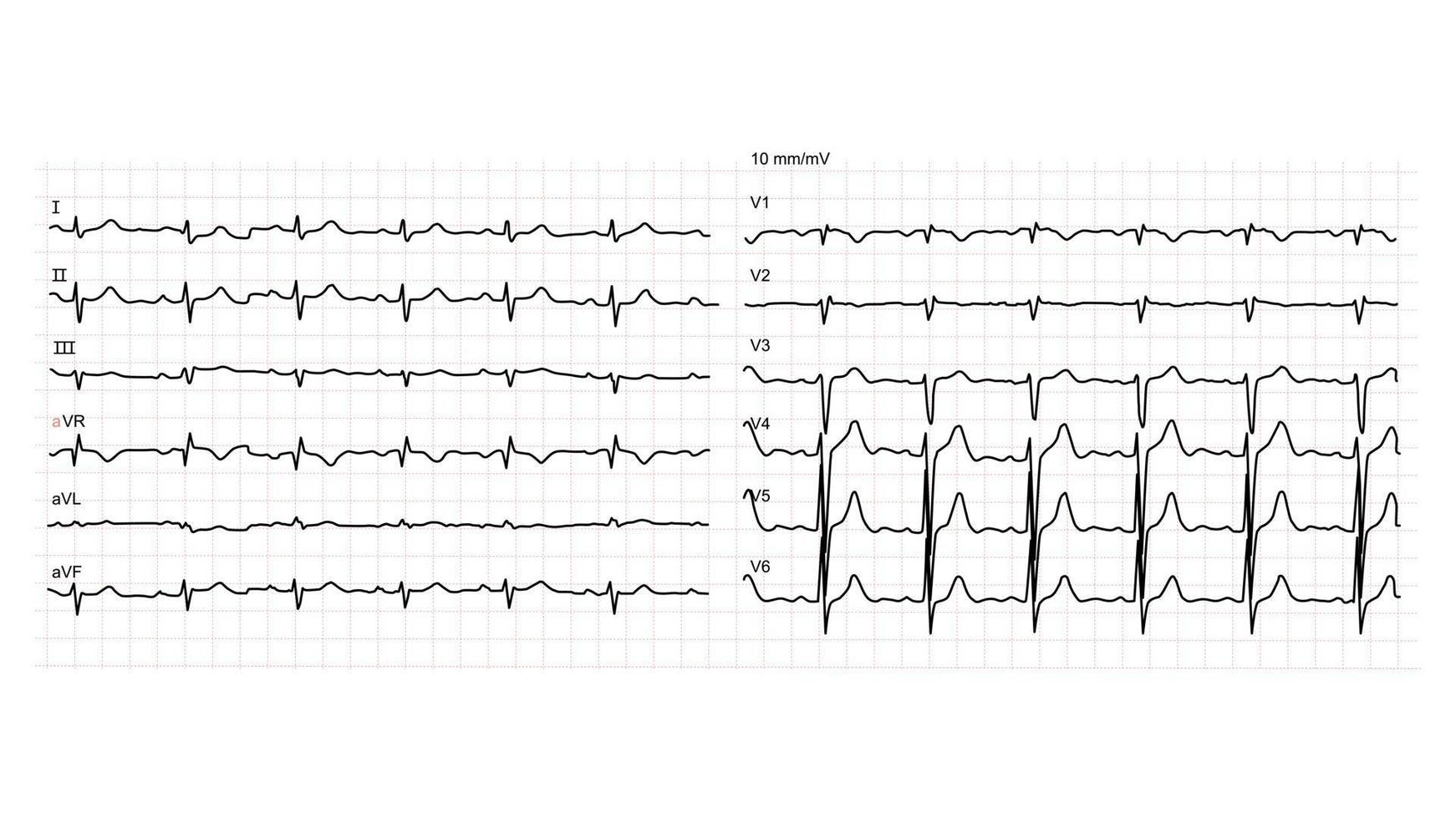 ilustración de electrocardiograma normal sobre fondo blanco. vector