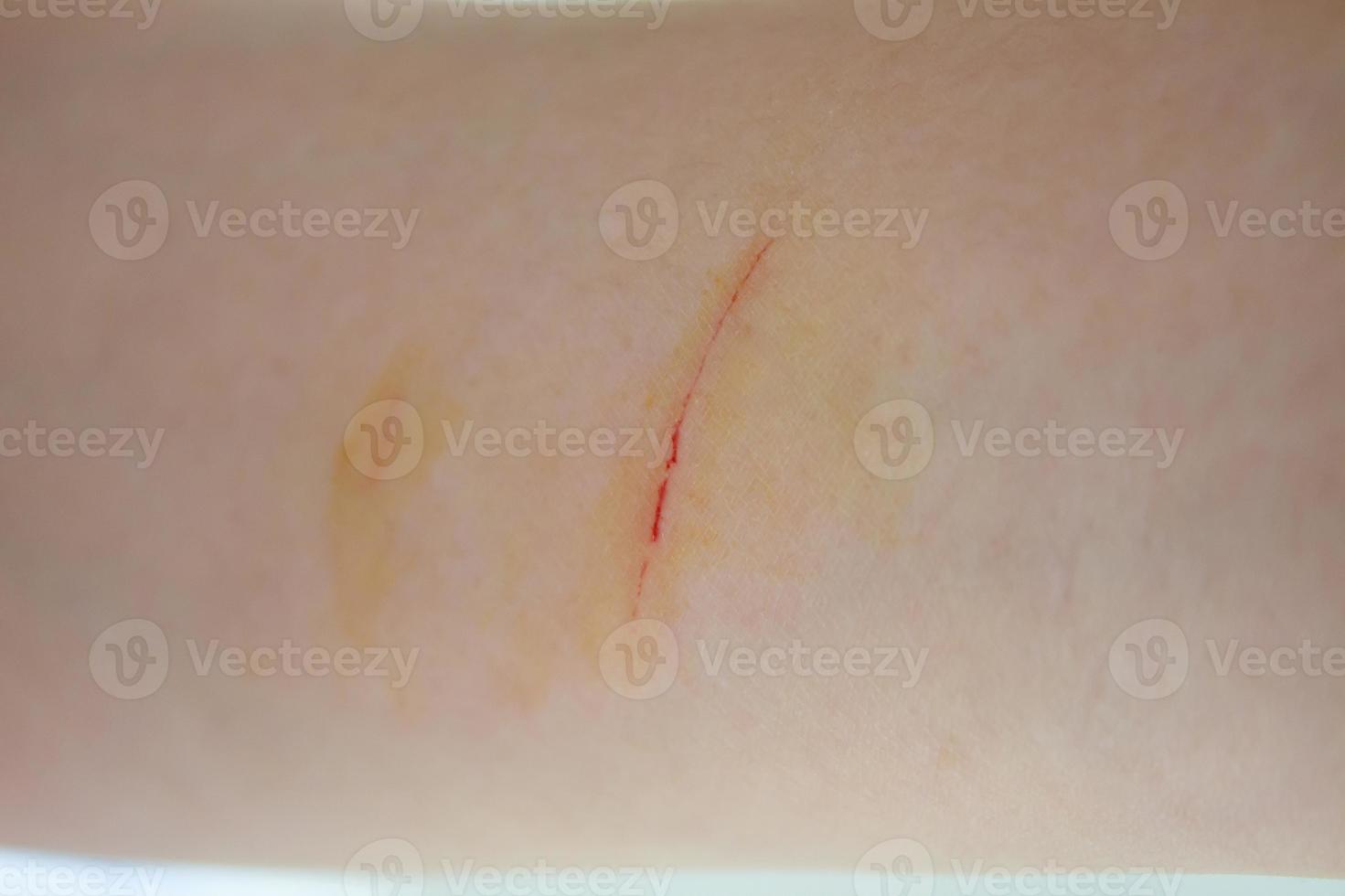 scratched wound on arm photo