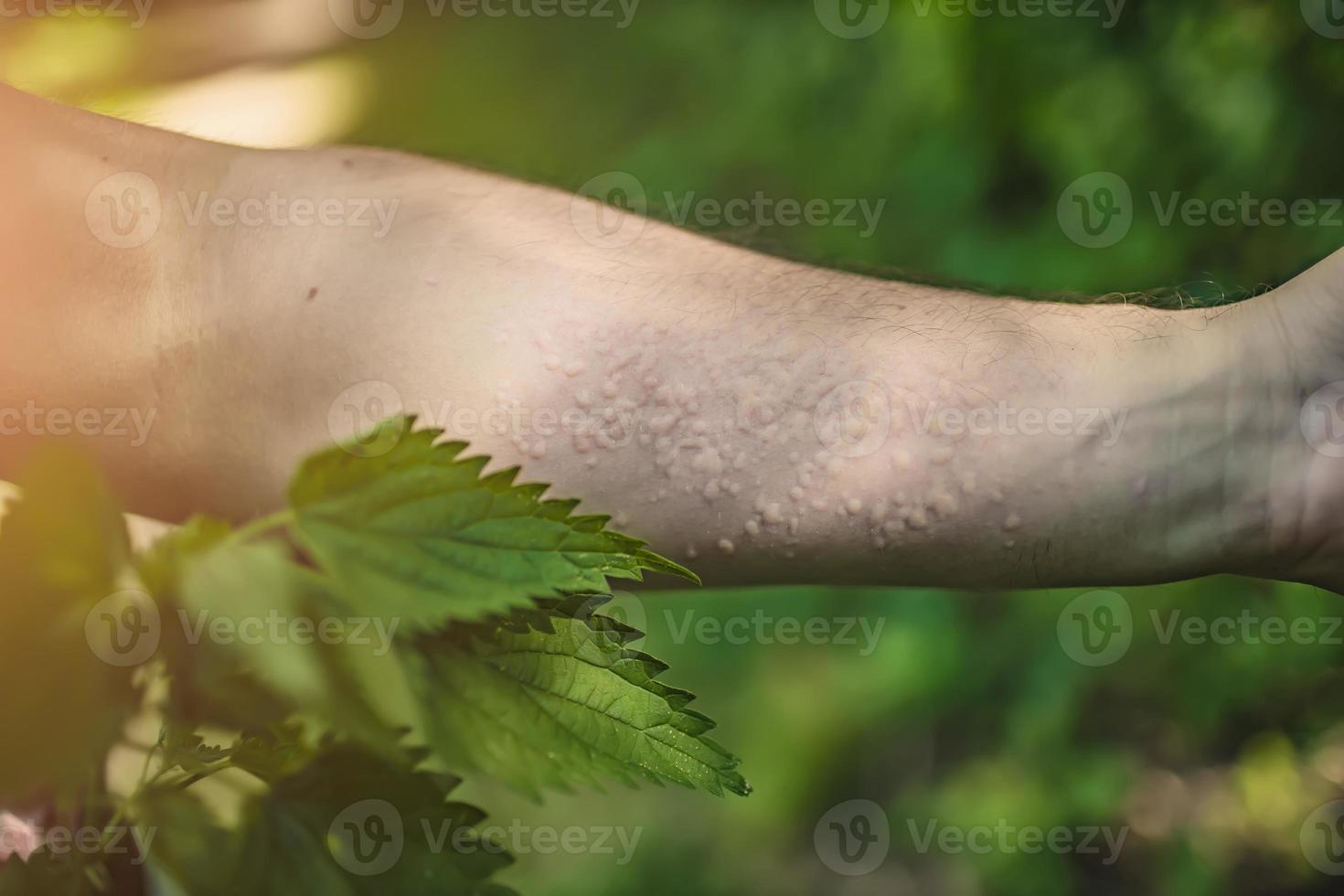 burn your hands with nettles closeup photo