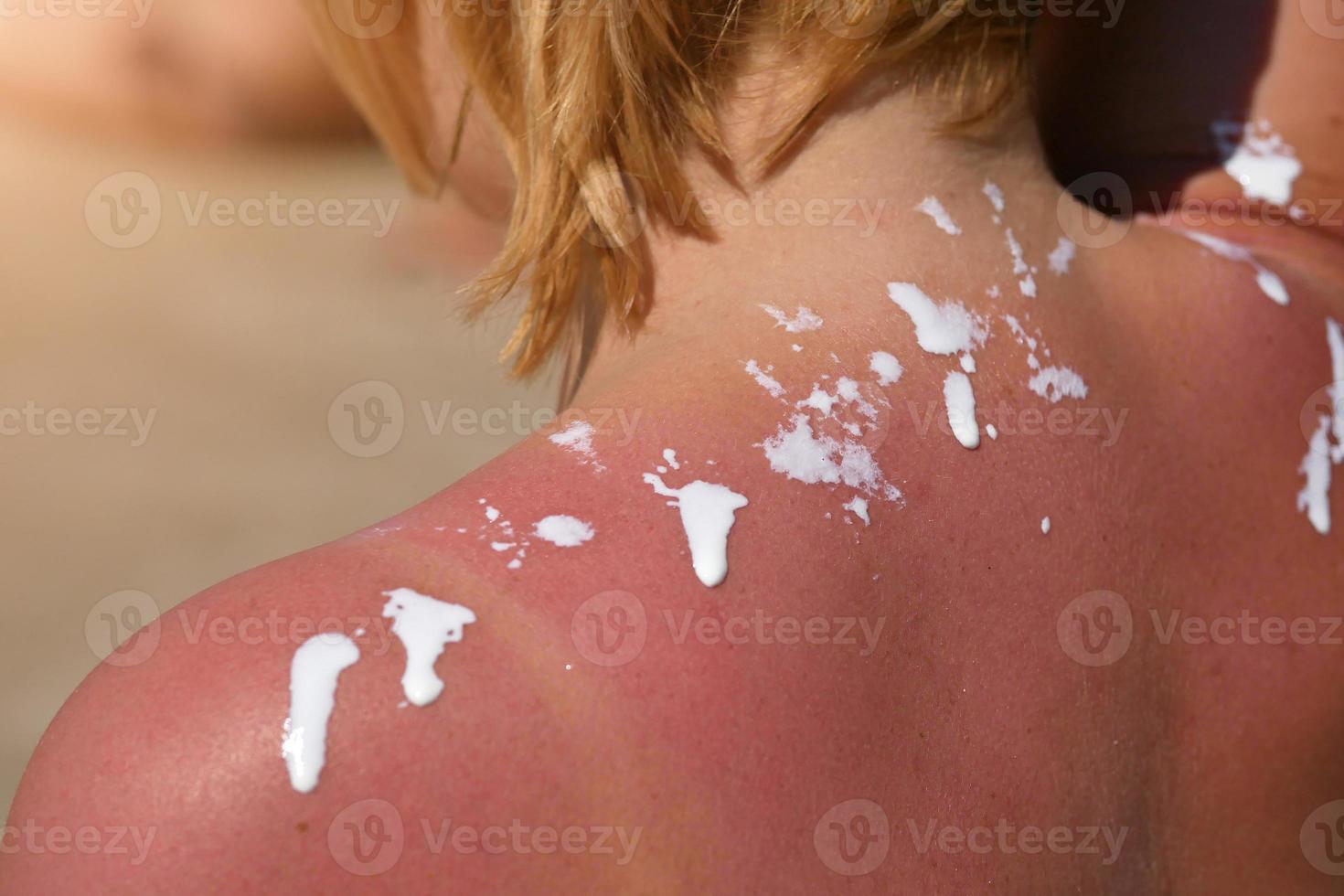 Woman rubs sunscreen on his shoulder. Against the background of the sea. photo