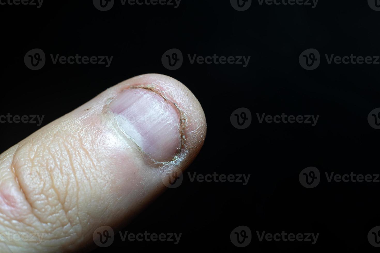 Bite toenail best sale