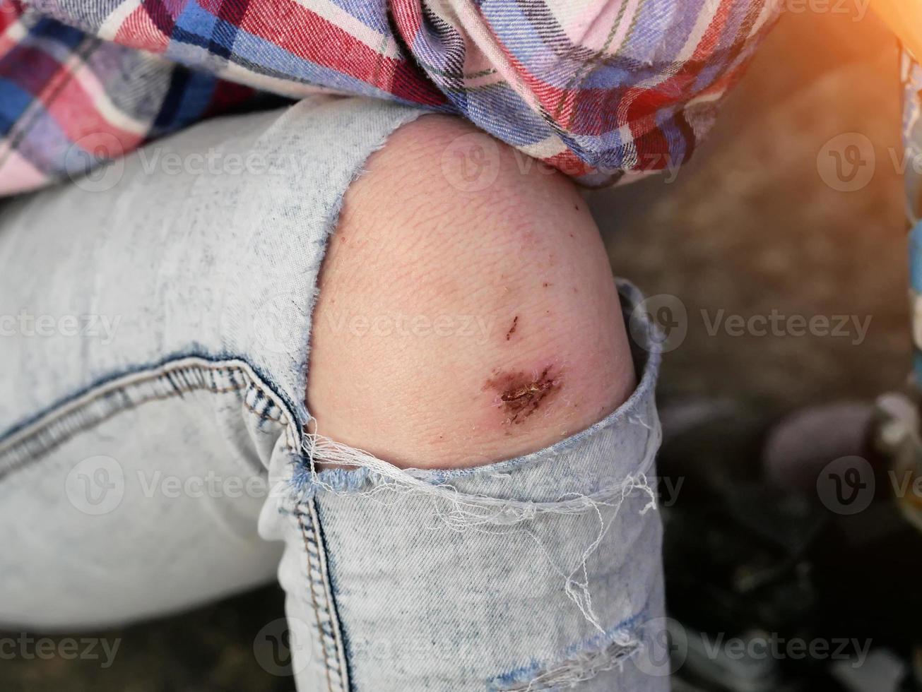 torn jeans and a broken knee. Open wound photo