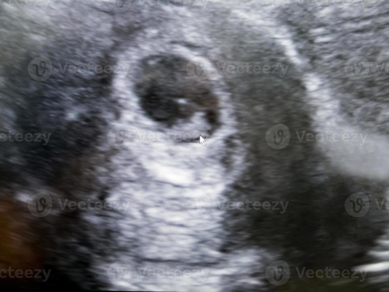 Obstetric Ultrasound of embryo at sixth week photo