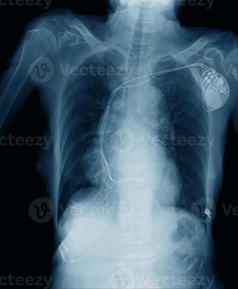 pacemaker cell in patient for keep working electrical wave in human photo