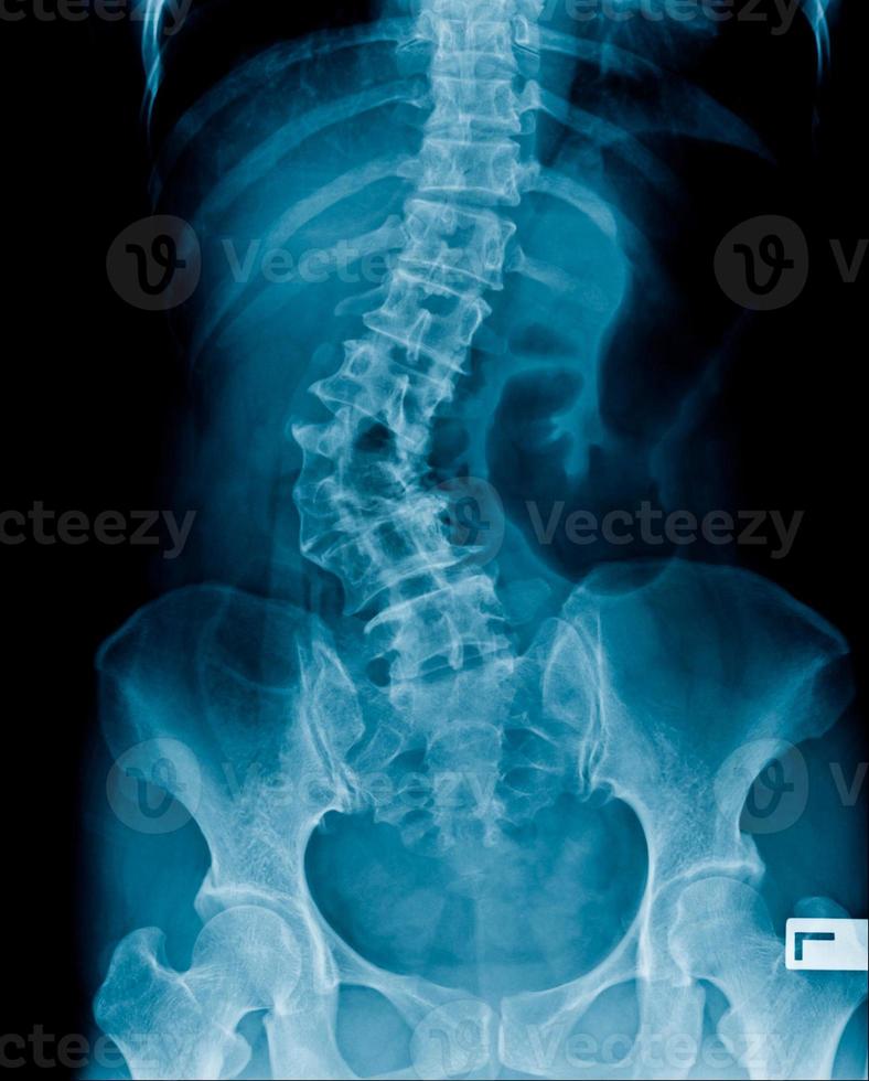 la imagen de rayos X del abdomen muestra la columna vertebral y el hueso pélvico, la espondilosis lumbar y el cambio degenerativo y la deformidad foto