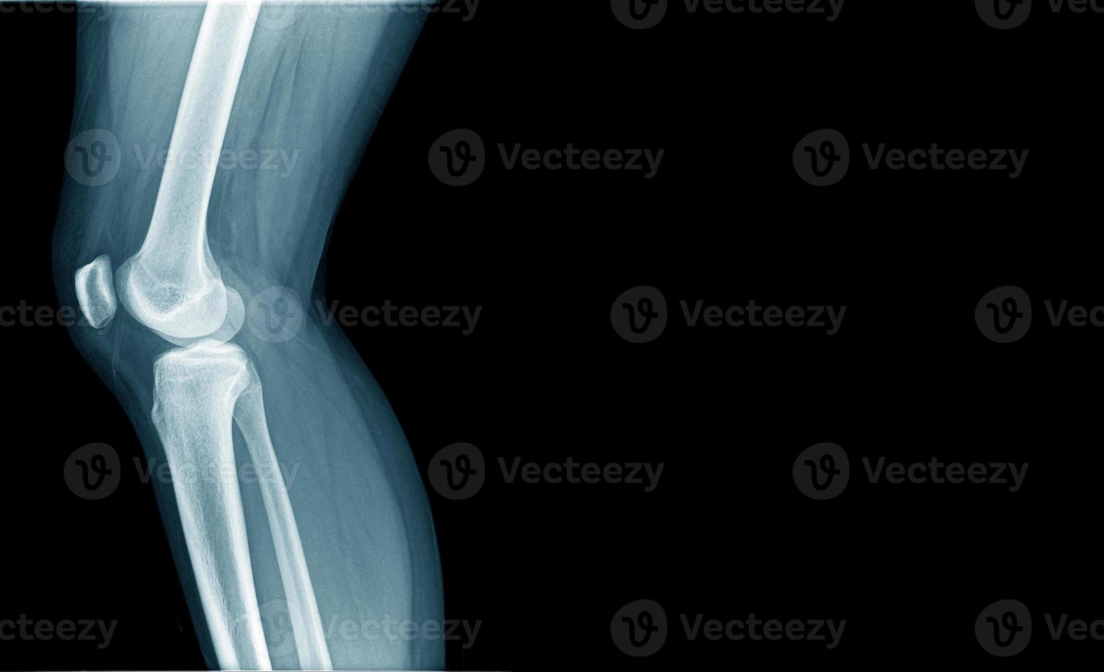 x-ray image og knee joint in blue tone photo