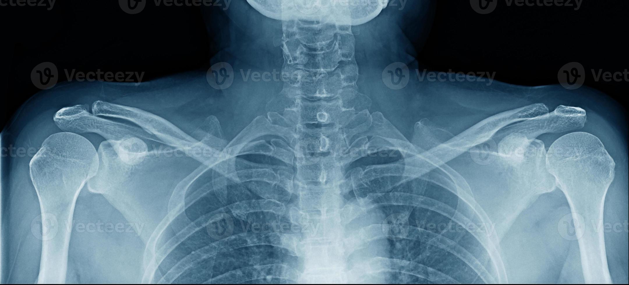 x-ray image of upper part photo